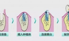 爆料种植牙套路视频播放,视频曝光惊人内幕